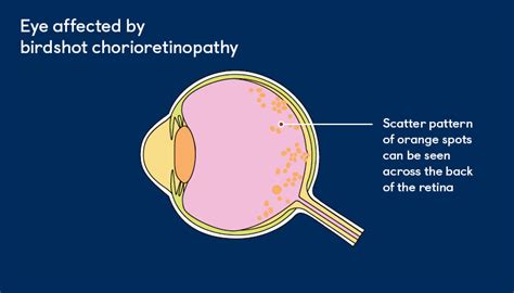 birdshot chorioretinopathy treatment.